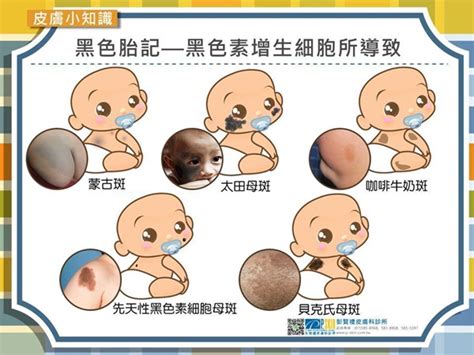 咖啡色胎記|蒙古斑、血管瘤、咖啡牛奶斑......嬰兒胎記大不同！9。